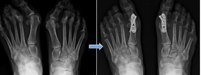 Im Röntgenbild dargestellt: ein Hallux valgus